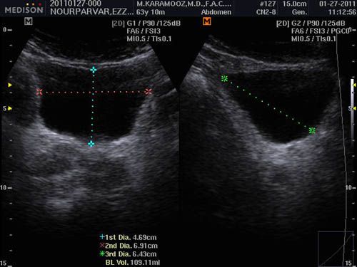 Samsung/Medison SonoAce R3 Portable Color Doppler Ultrasound System 